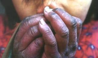 艾滋病最初皮疹图片 艾滋病最初皮疹图片